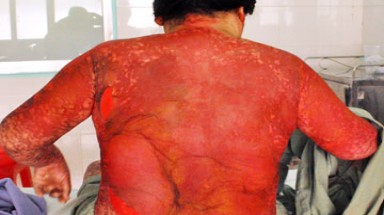 Uống thực phẩm chức năng bị lột da lưng