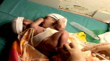  Hai bé sinh đôi dính nhau nhiều bộ phận