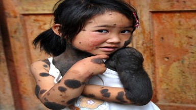  Bệnh "lạ": Bé gái mọc lông thú đầy người