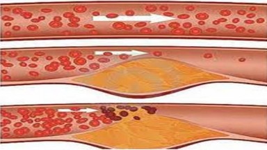 Rối loạn lipit máu có liên quan tới đột quỵ?
