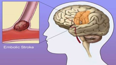  Bỏ thuốc lá, chất béo để ngăn chặn đột quỵ não