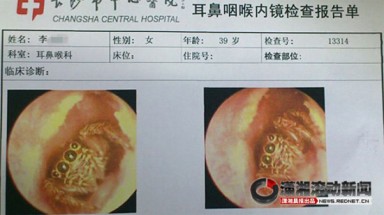  Nhện ngủ trong tai người suốt 5 ngày