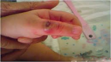  Cách điều trị nhiễm khuẩn bàn tay?