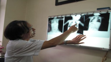  Cứu sống bé 1 tuổi đã ngừng thở vì... hóc thạch