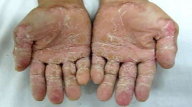Bệnh lạ ở Quảng Ngãi, Hòa Bình là do nhiễm độc từ môi trường?