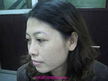 Trị[-]nám[-]da[-]với[-]y[-]học[-]cổ[-]truyền,[-]Sức[-]khỏe[-]đời[-]sống,[-]
